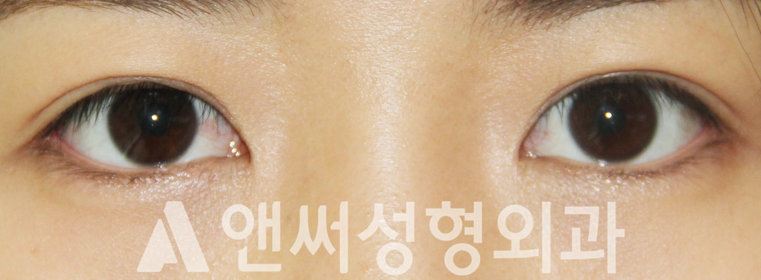Answer Plastic Surgery case 528: After