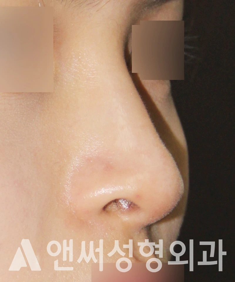 Answer Plastic Surgery case 527: Before