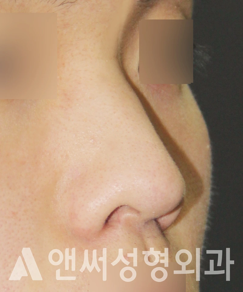 Answer Plastic Surgery case 526: Before