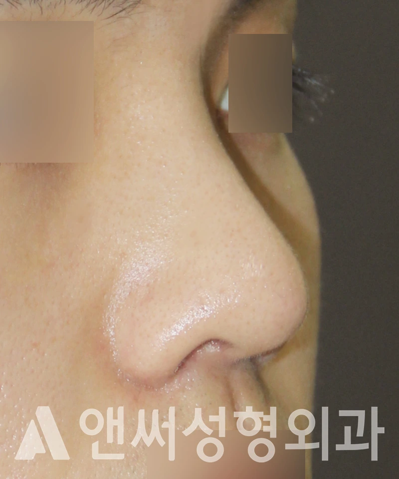 Answer Plastic Surgery case 526: After