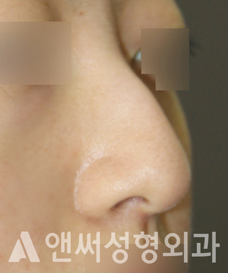 Answer Plastic Surgery case 525: Before