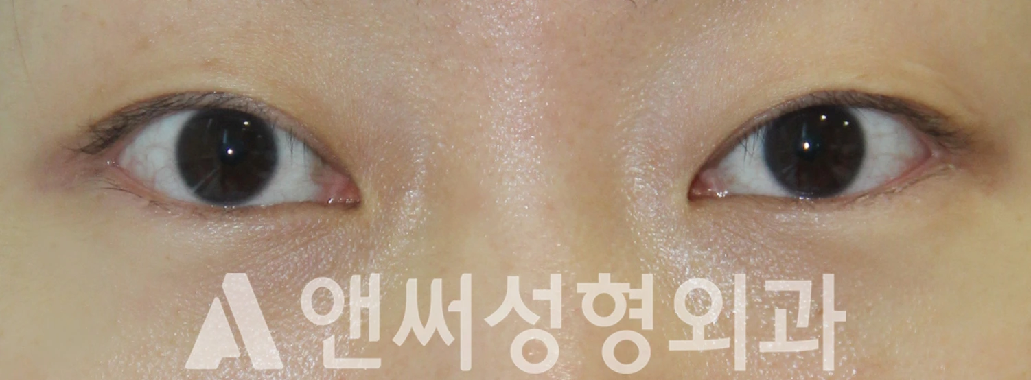 Answer Plastic Surgery case 524: Before