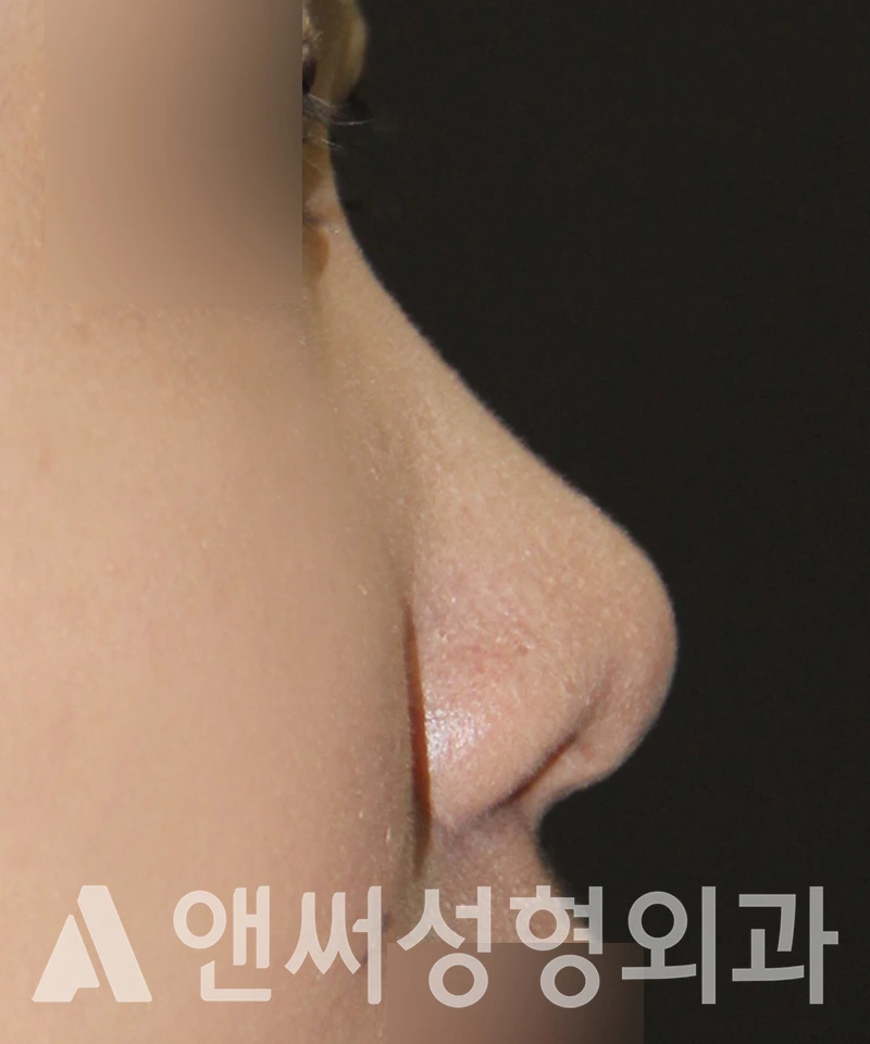 Answer Plastic Surgery case 523: Before