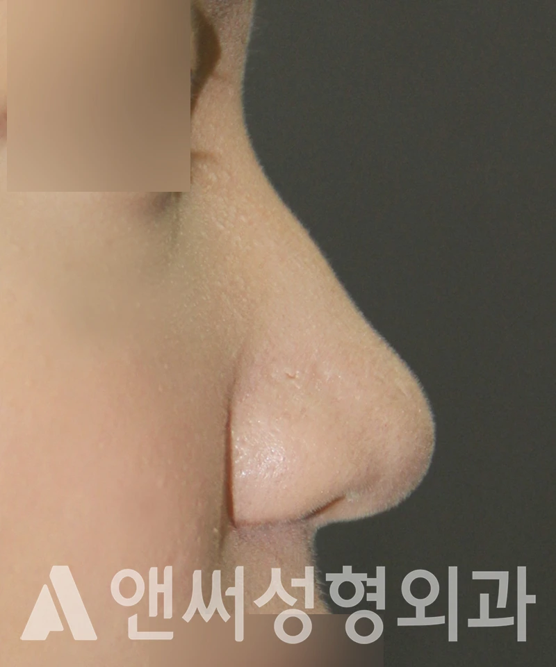 Answer Plastic Surgery case 522: Before
