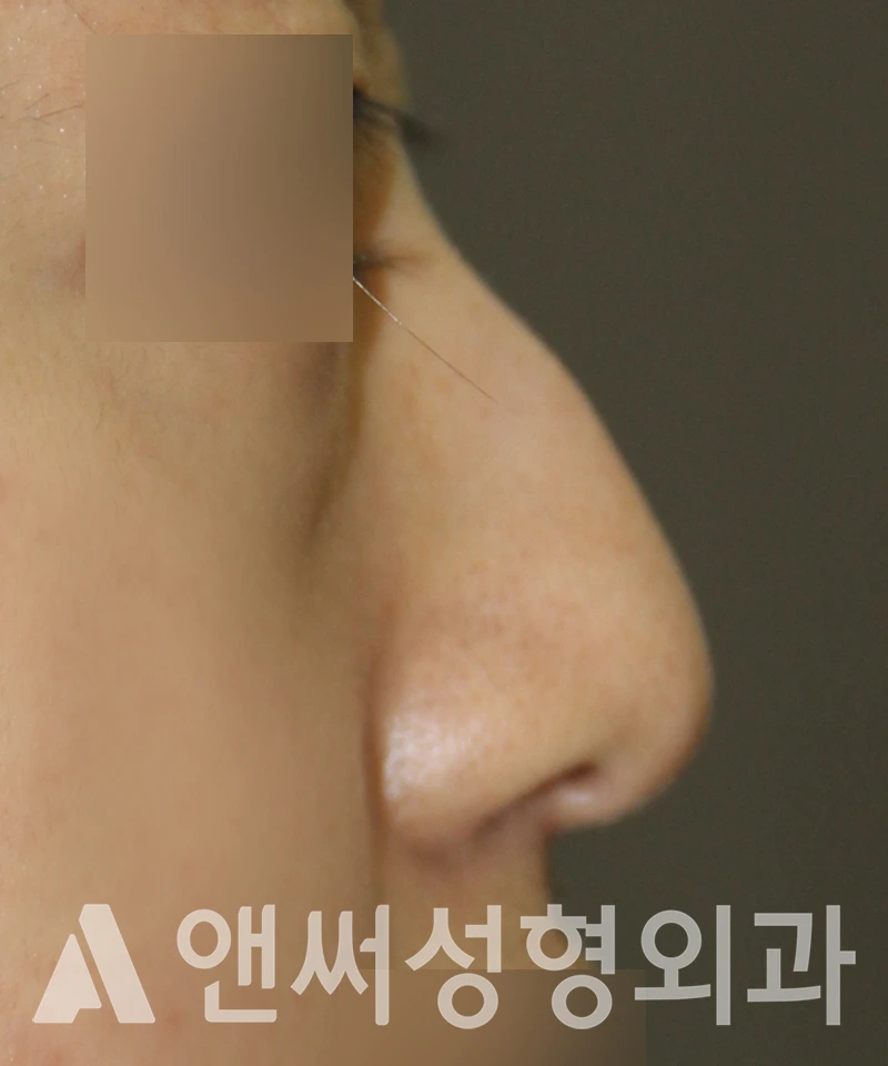 Answer Plastic Surgery case 521: Before