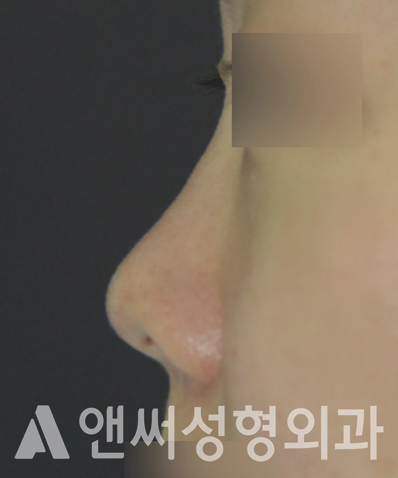 Answer Plastic Surgery case 520: Before