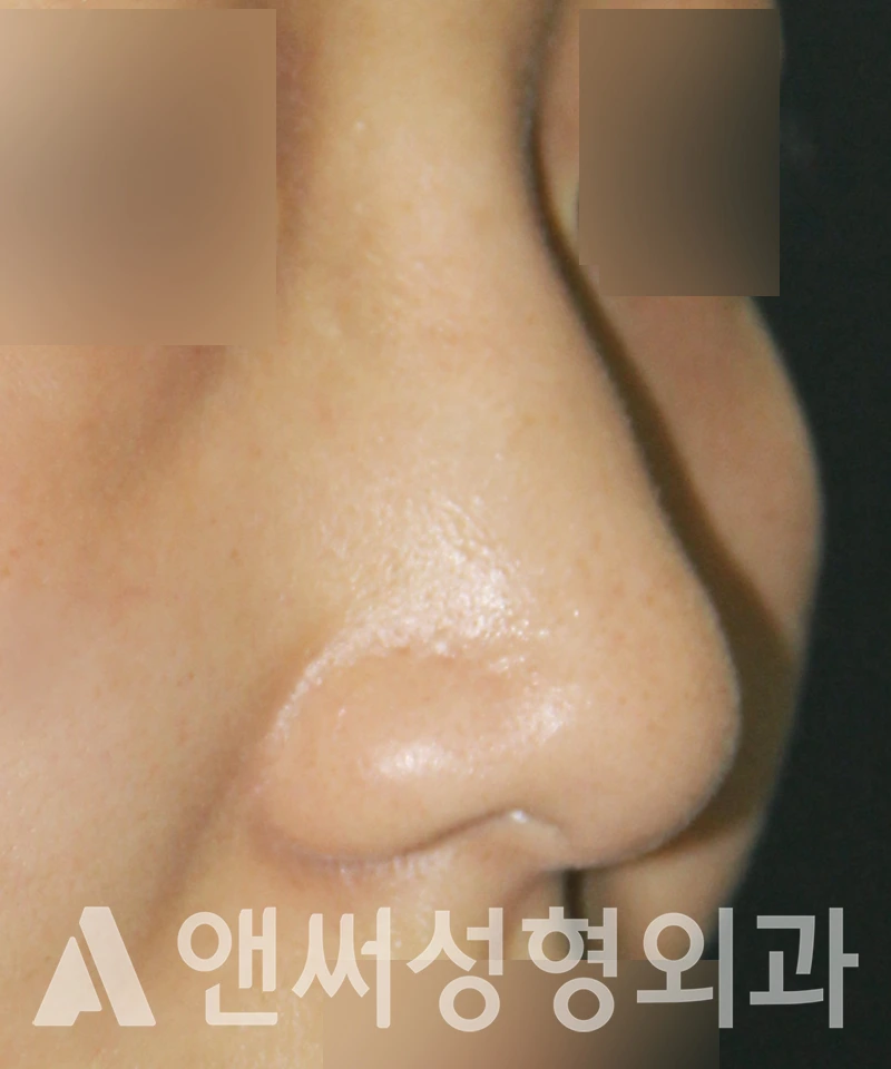 Answer Plastic Surgery case 519: Before