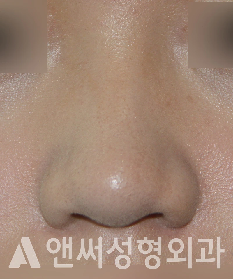 Answer Plastic Surgery case 518: Before