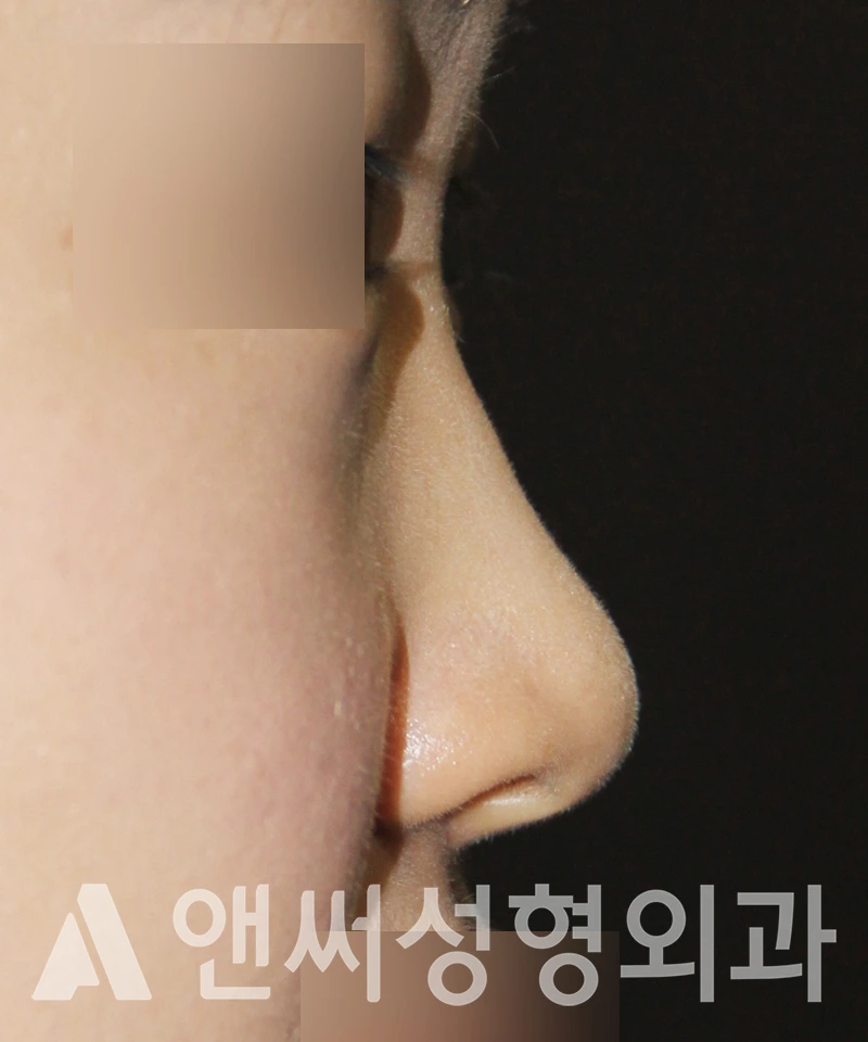 Answer Plastic Surgery case 517: Before