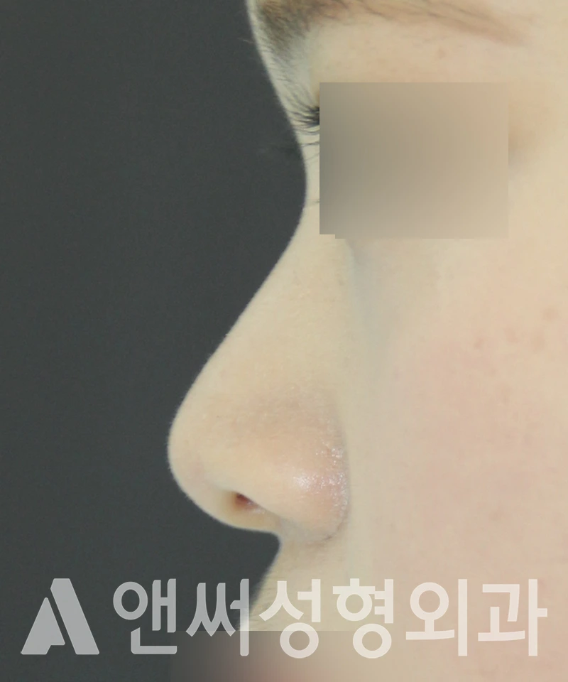 Answer Plastic Surgery case 516: Before