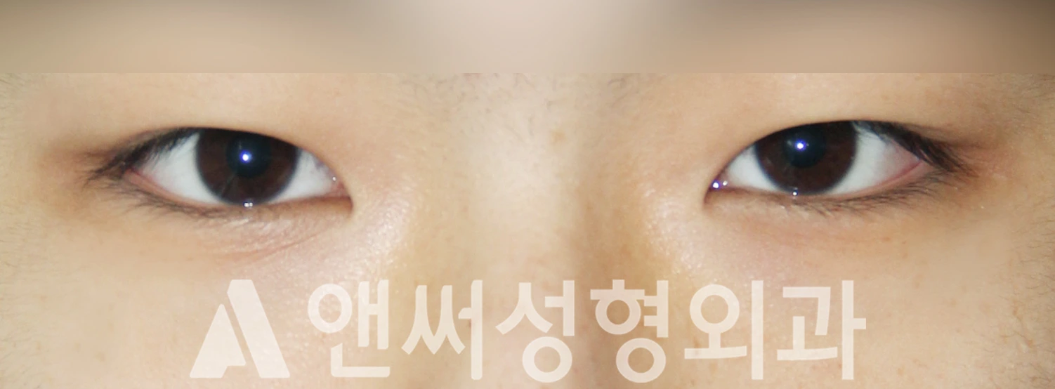 Answer Plastic Surgery case 515: Before