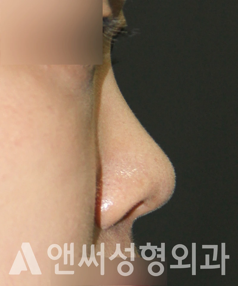 Answer Plastic Surgery case 514: Before