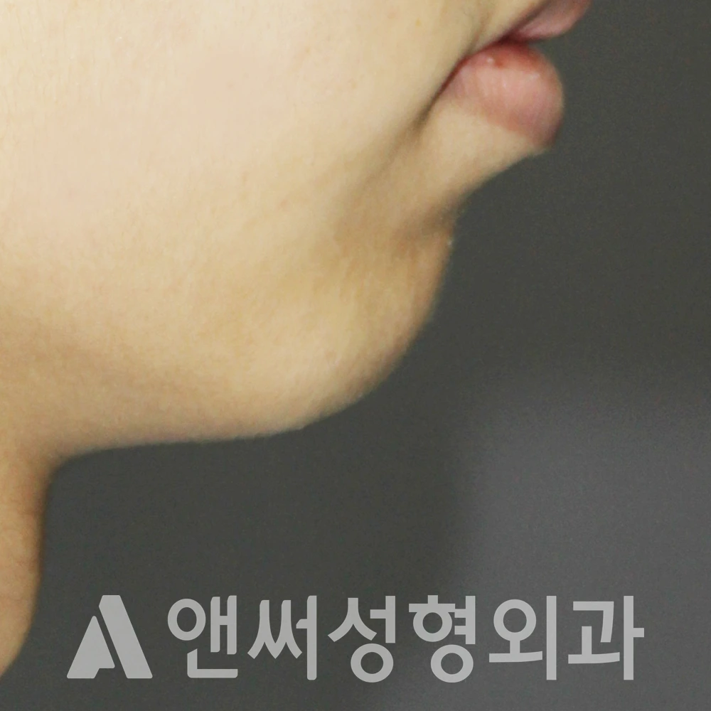 Answer Plastic Surgery case 513: Before