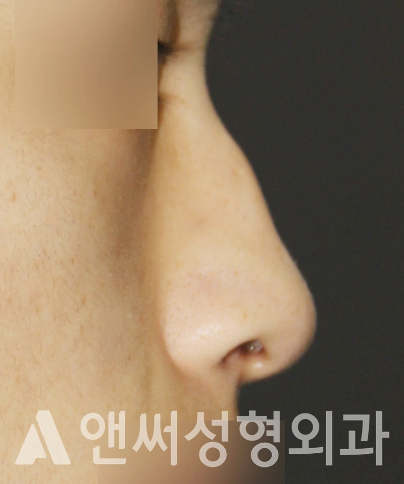 Answer Plastic Surgery case 512: Before