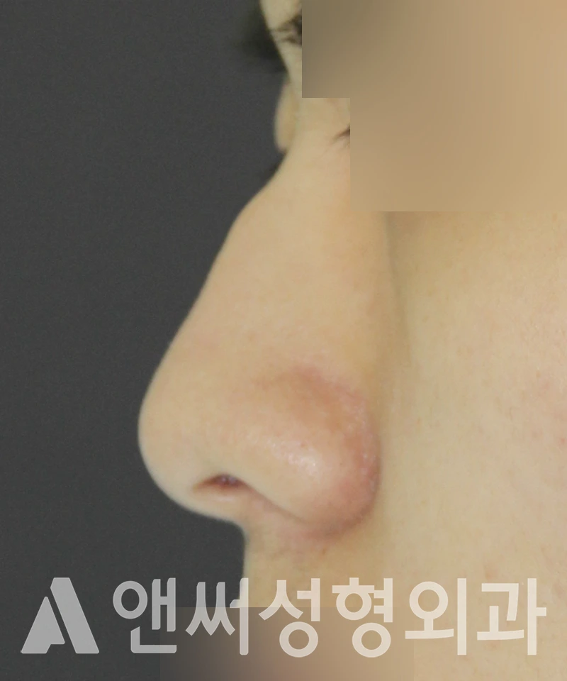 Answer Plastic Surgery case 511: Before