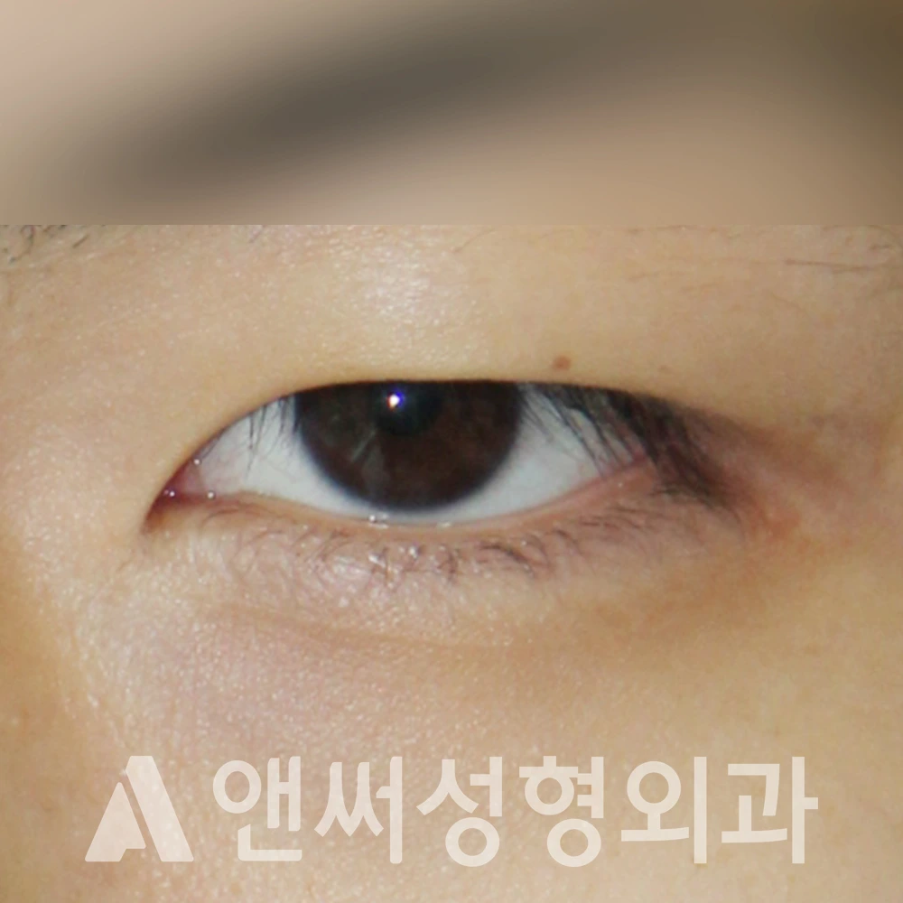 Answer Plastic Surgery case 510: Before