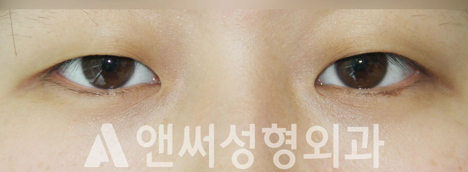 Answer Plastic Surgery case 508: Before