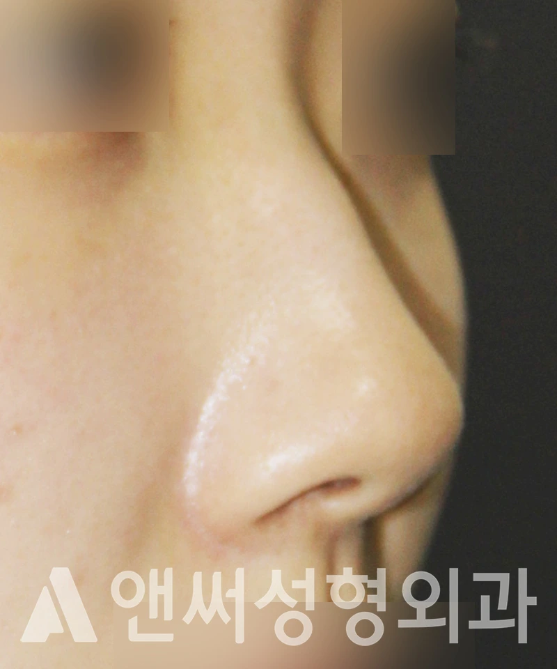 Answer Plastic Surgery case 507: Before