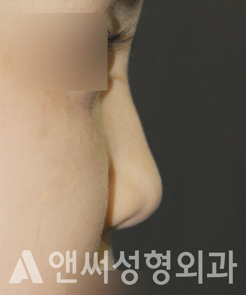 Answer Plastic Surgery case 506: Before