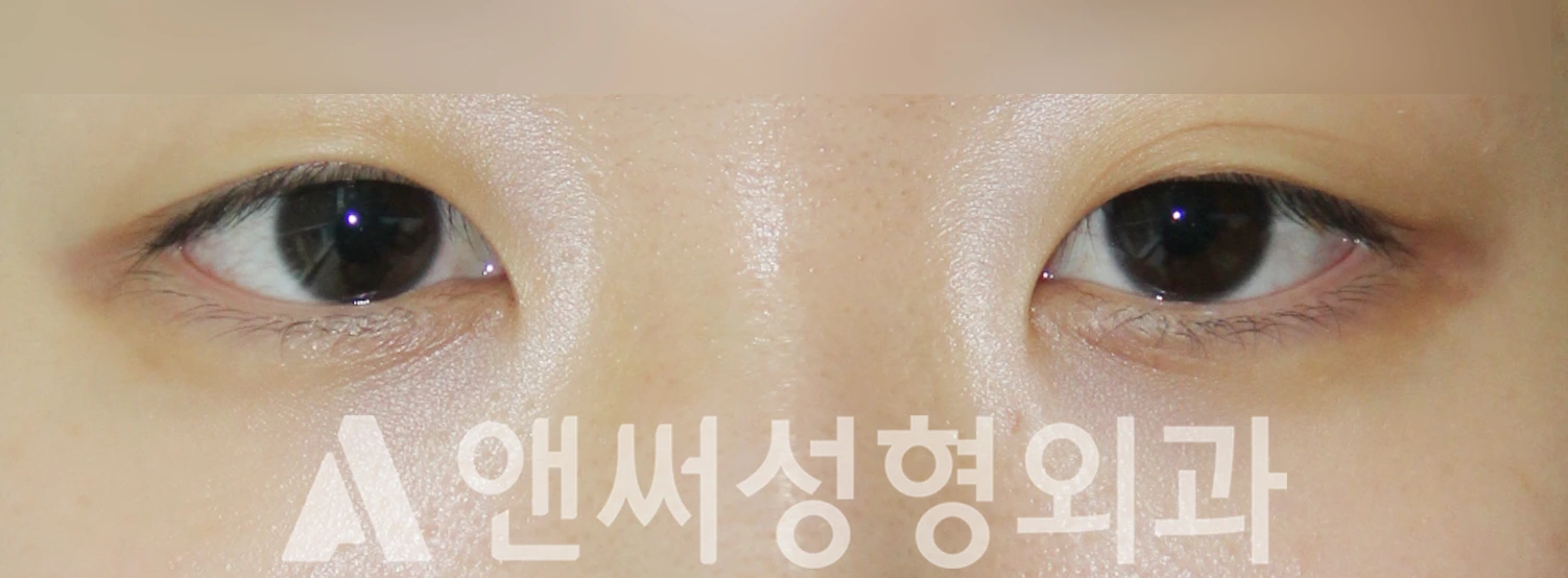 Answer Plastic Surgery case 505: Before