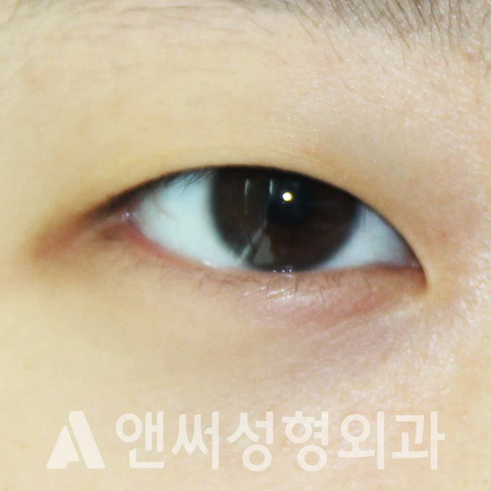 Answer Plastic Surgery case 504: Before