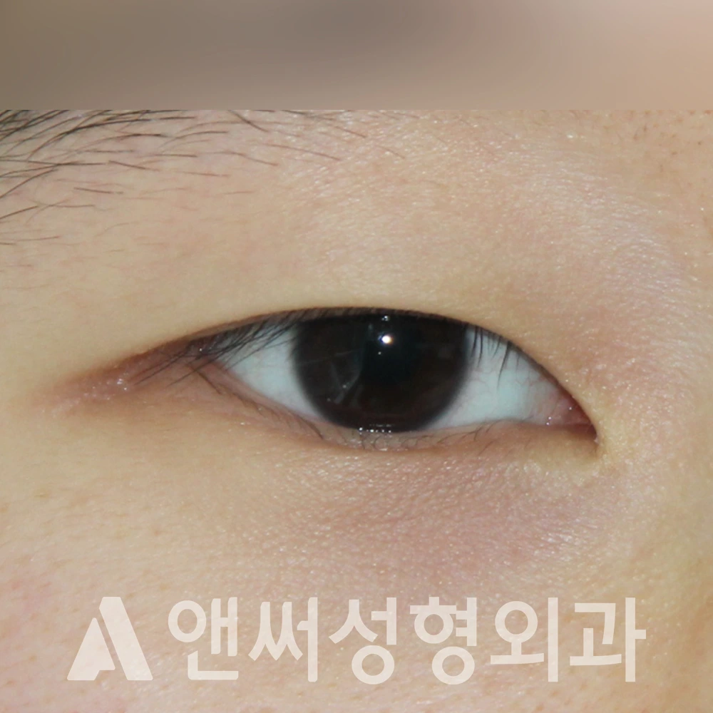 Answer Plastic Surgery case 503: Before