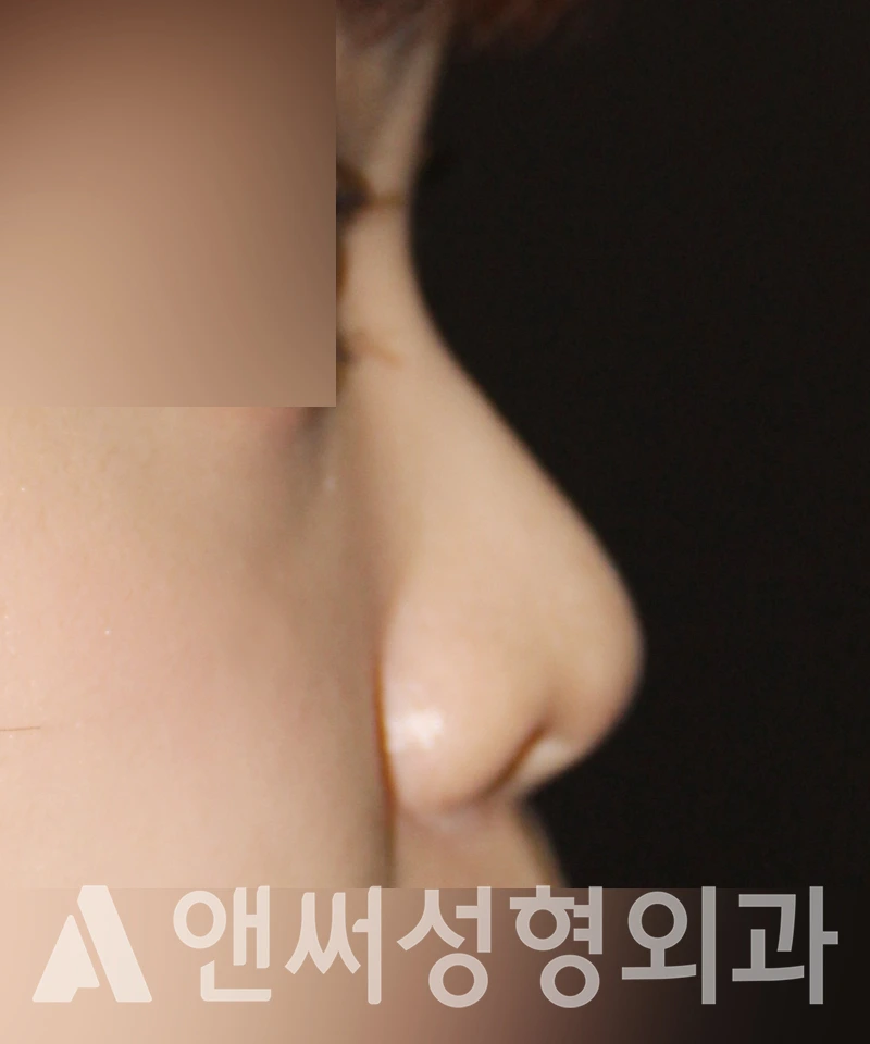 Answer Plastic Surgery case 501: Before