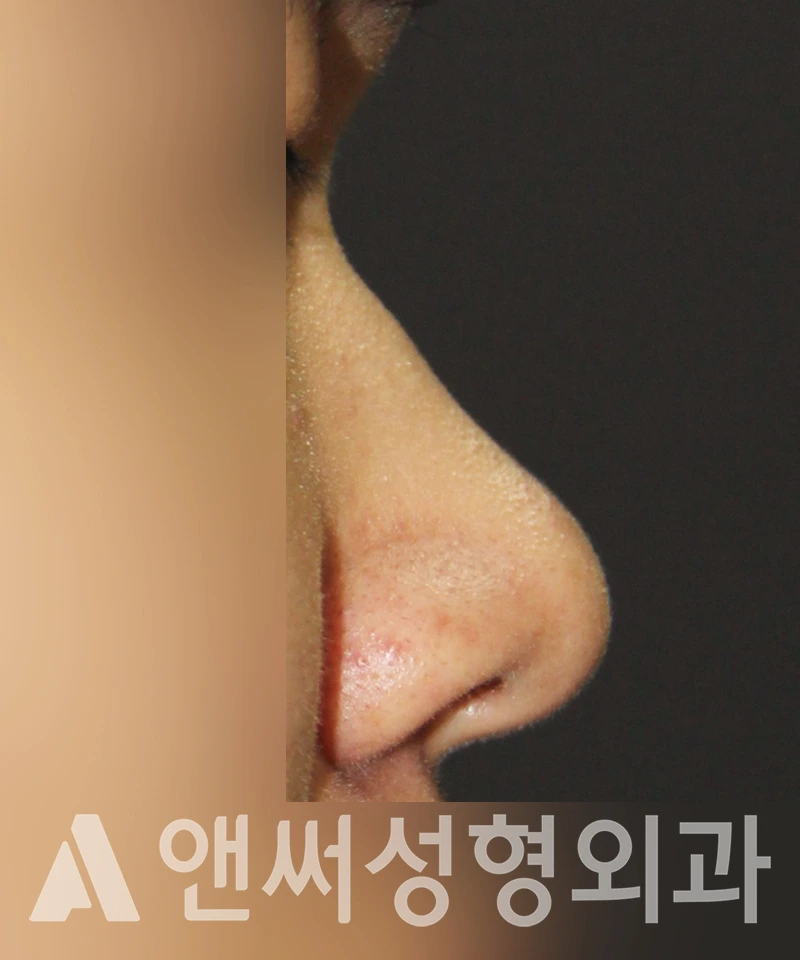 Answer Plastic Surgery case 500: Before
