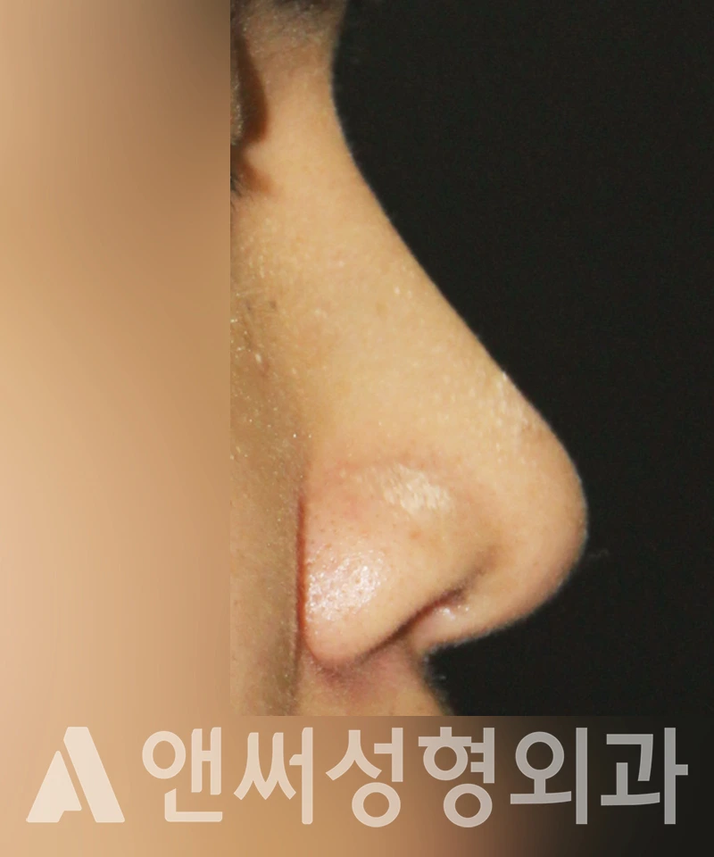 Answer Plastic Surgery case 500: After