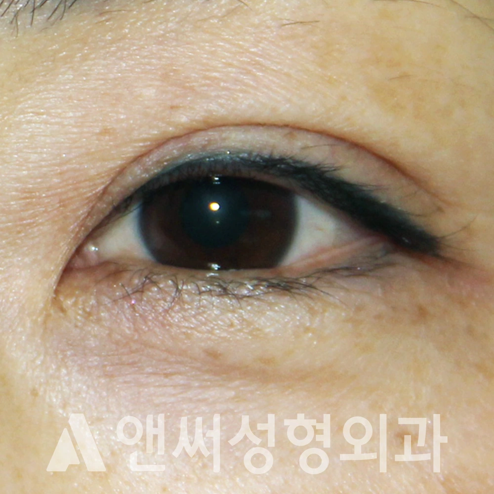 Answer Plastic Surgery case 498: Before
