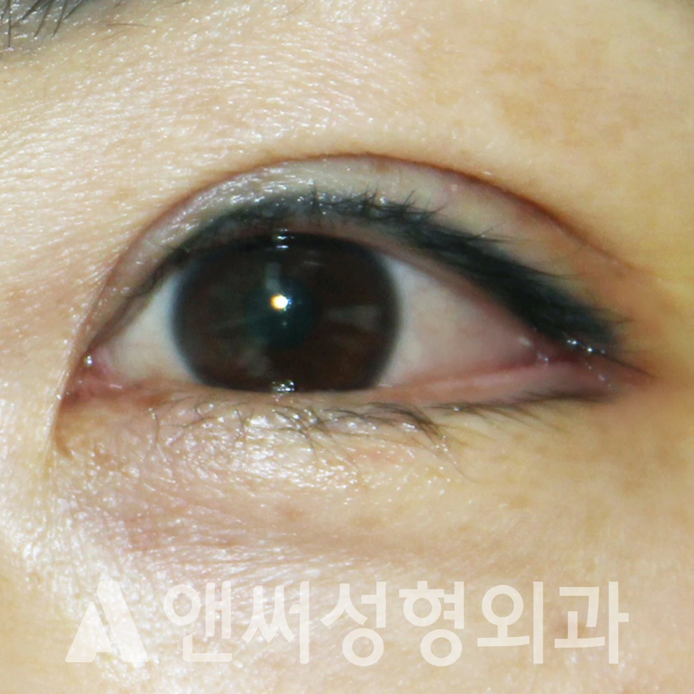 Answer Plastic Surgery case 498: After