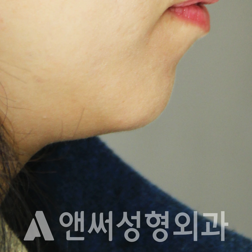 Answer Plastic Surgery case 497: Before