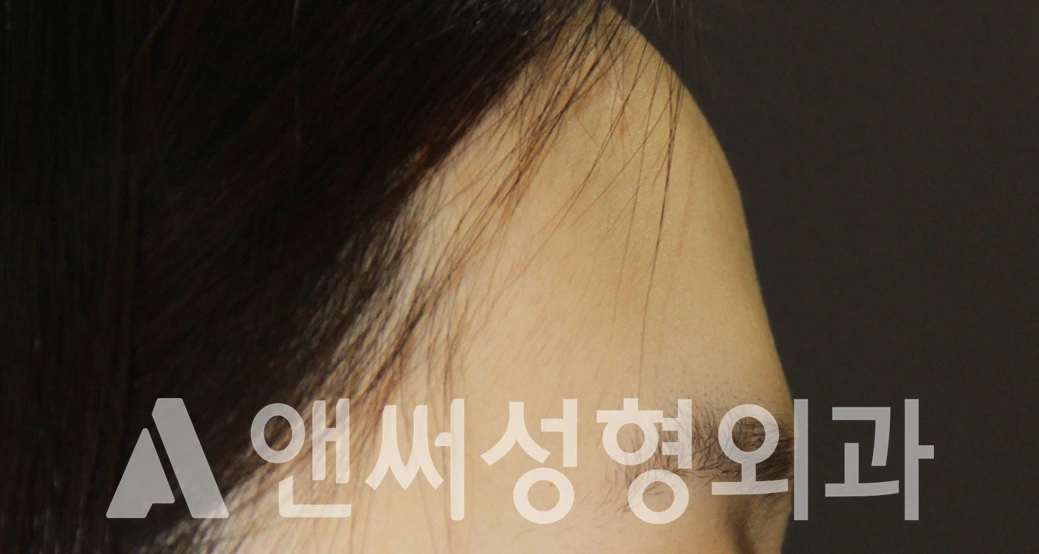 Answer Plastic Surgery case 495: Before
