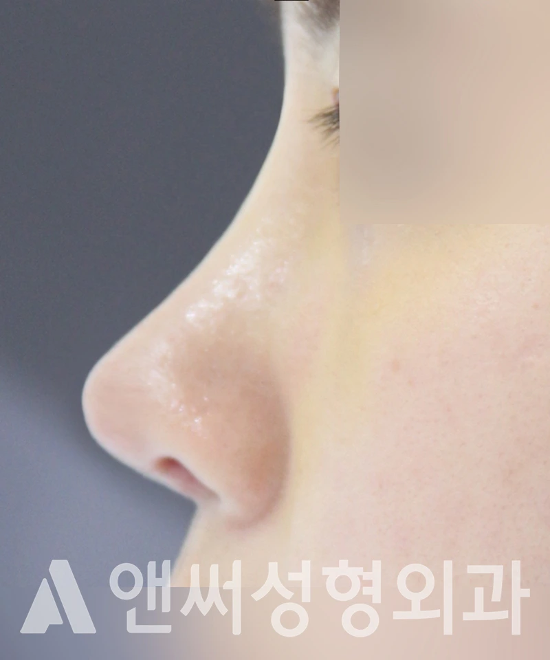 Answer Plastic Surgery case 493: After