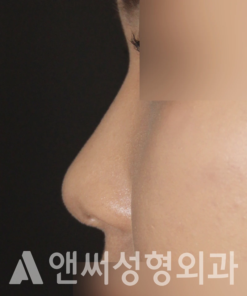 Answer Plastic Surgery case 492: Before