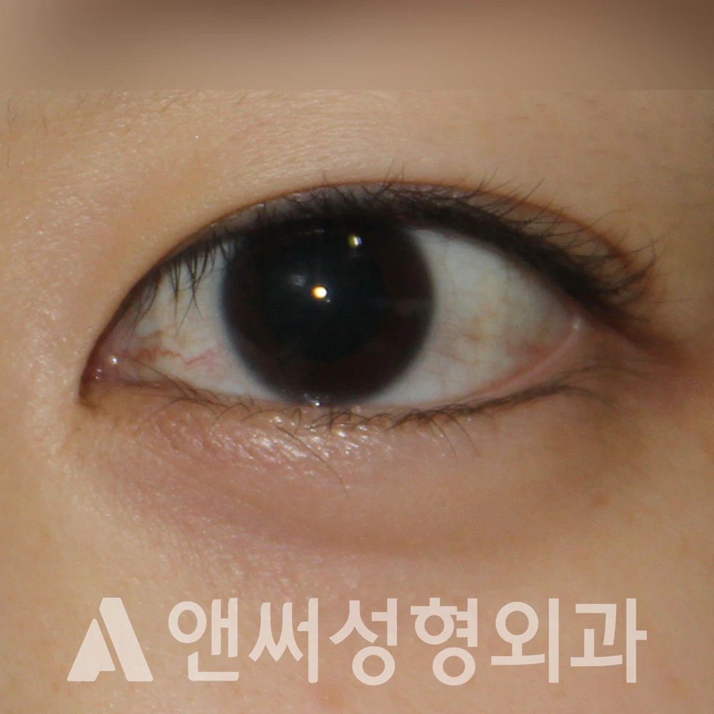 Answer Plastic Surgery case 487: Before