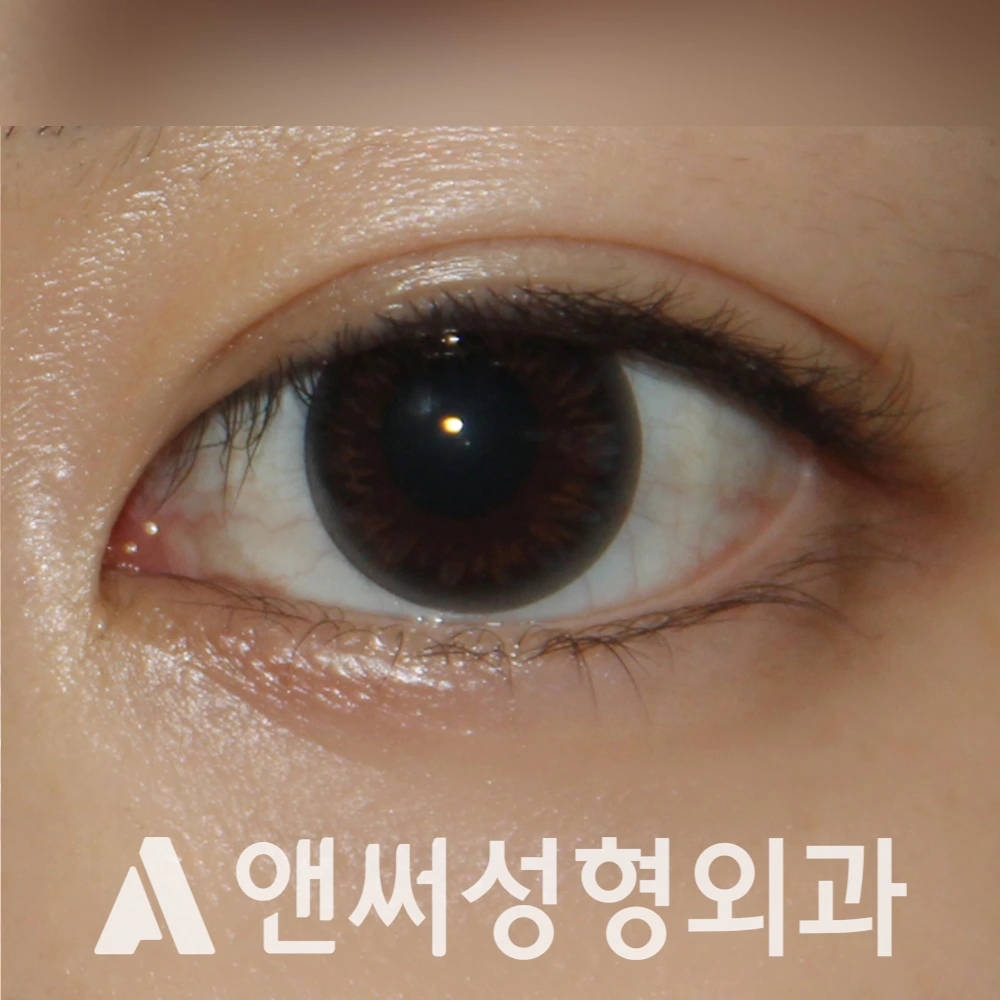 Answer Plastic Surgery case 487: After