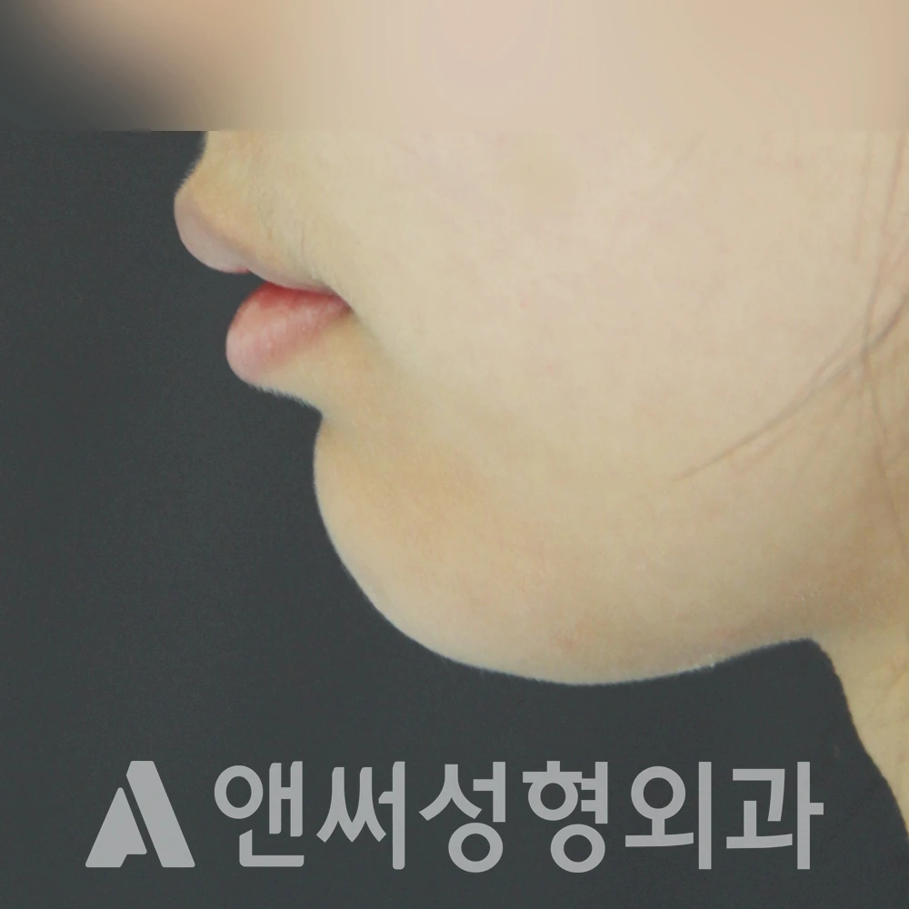 Answer Plastic Surgery case 485: Before