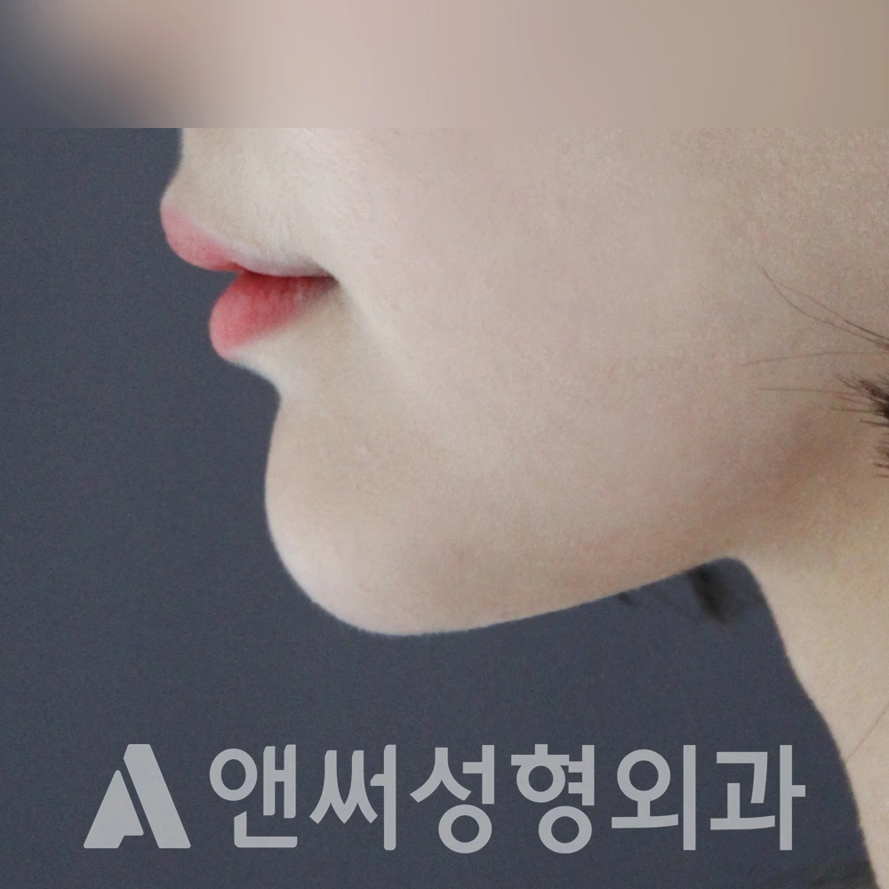Answer Plastic Surgery case 485: After