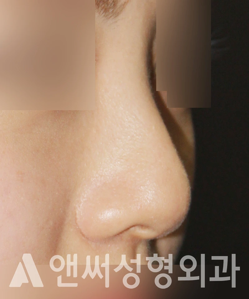 Answer Plastic Surgery case 484: Before