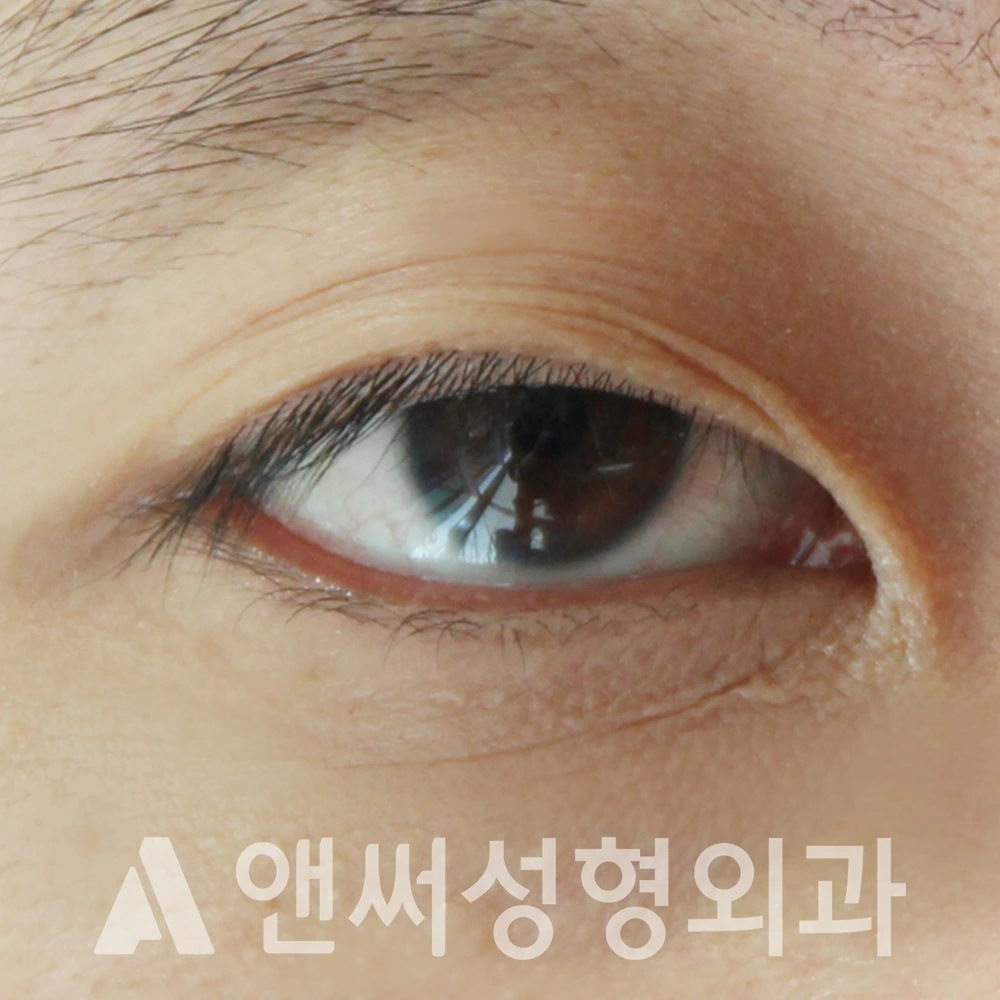 Answer Plastic Surgery case 483: Before