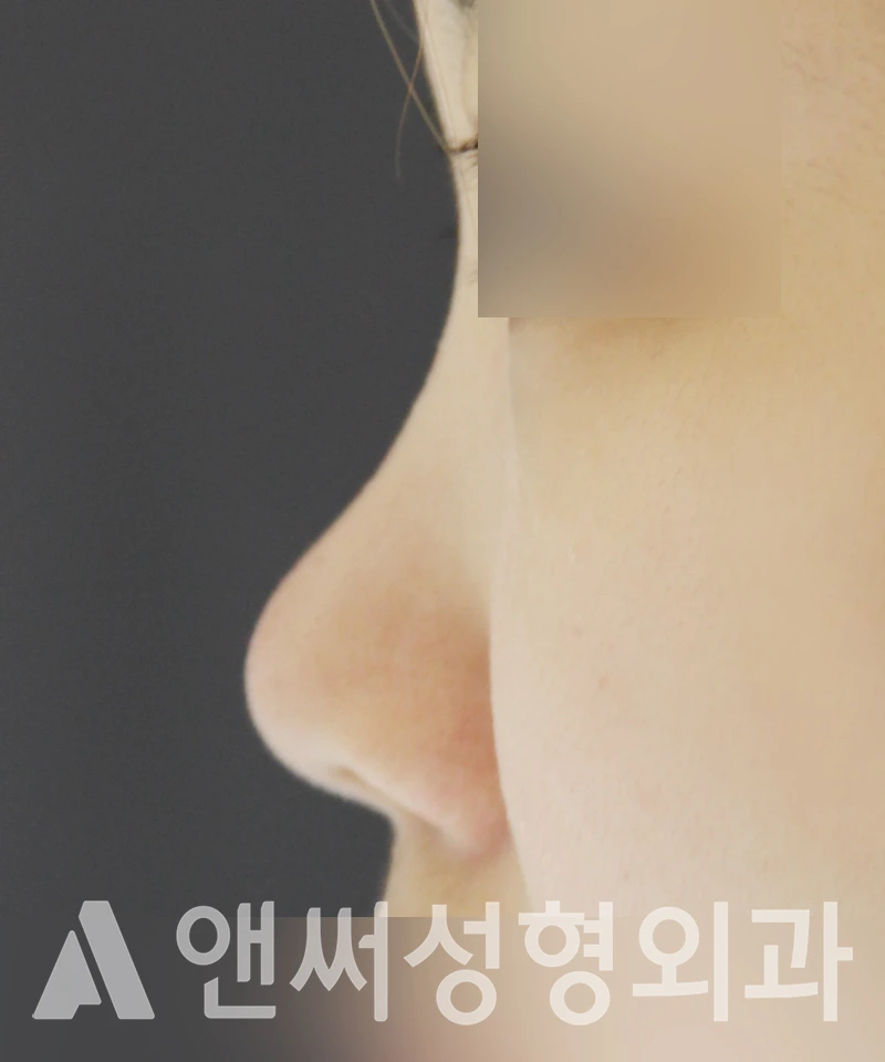 Answer Plastic Surgery case 482: Before