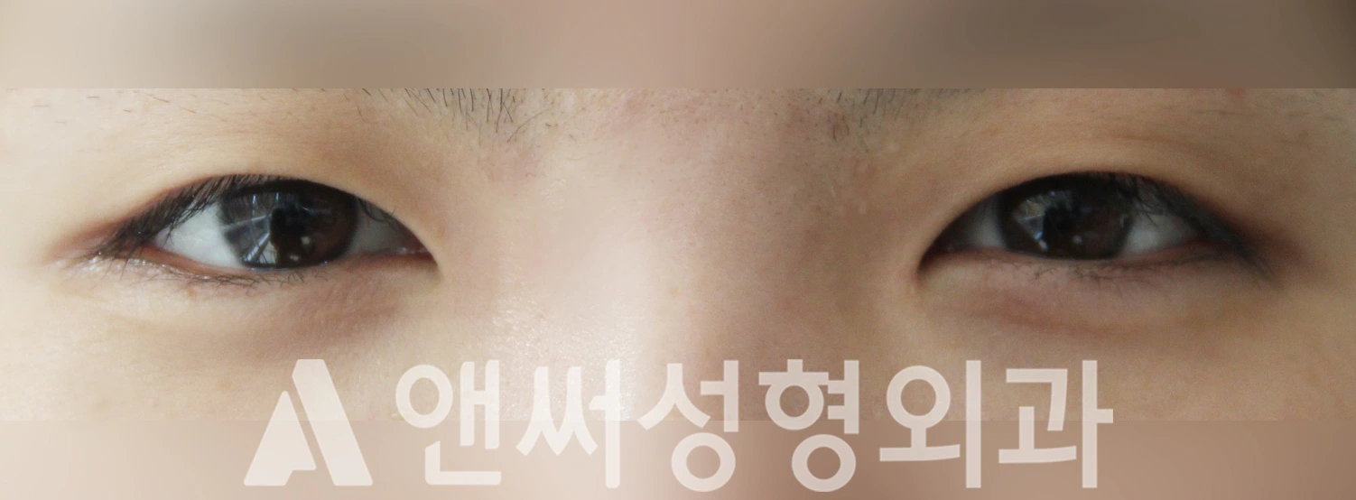 Answer Plastic Surgery case 481: Before