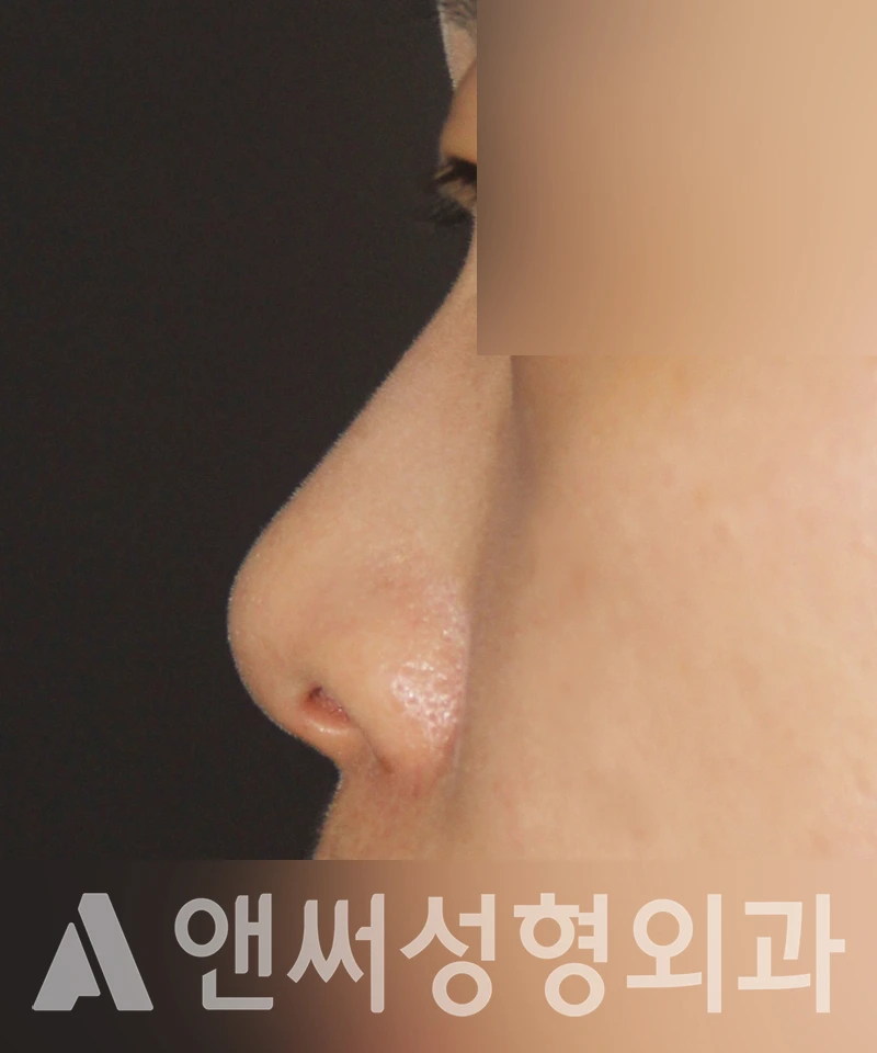 Answer Plastic Surgery case 455: Before