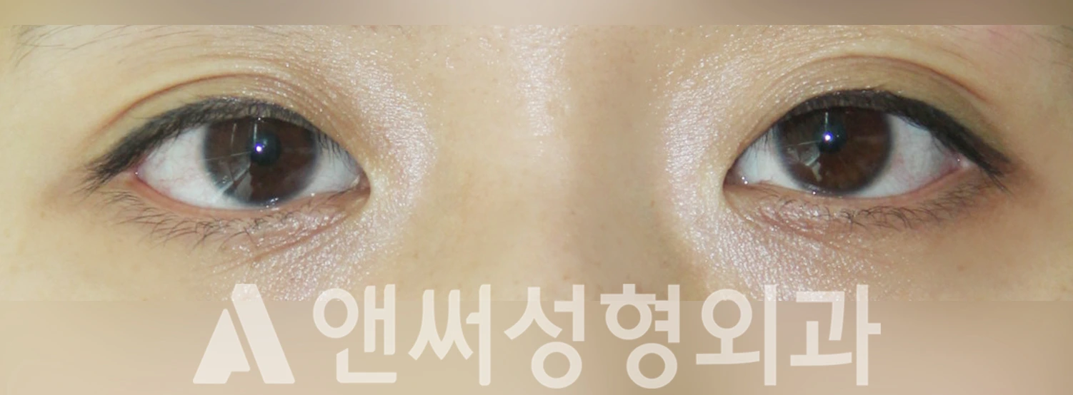 Answer Plastic Surgery case 454: Before