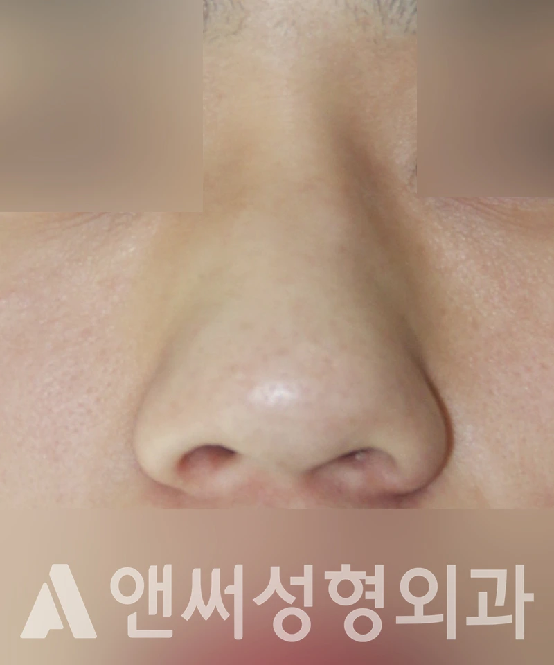 Answer Plastic Surgery case 453: Before