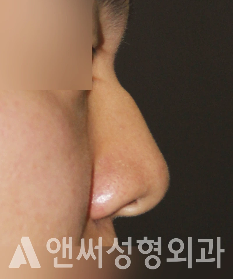 Answer Plastic Surgery case 452: Before