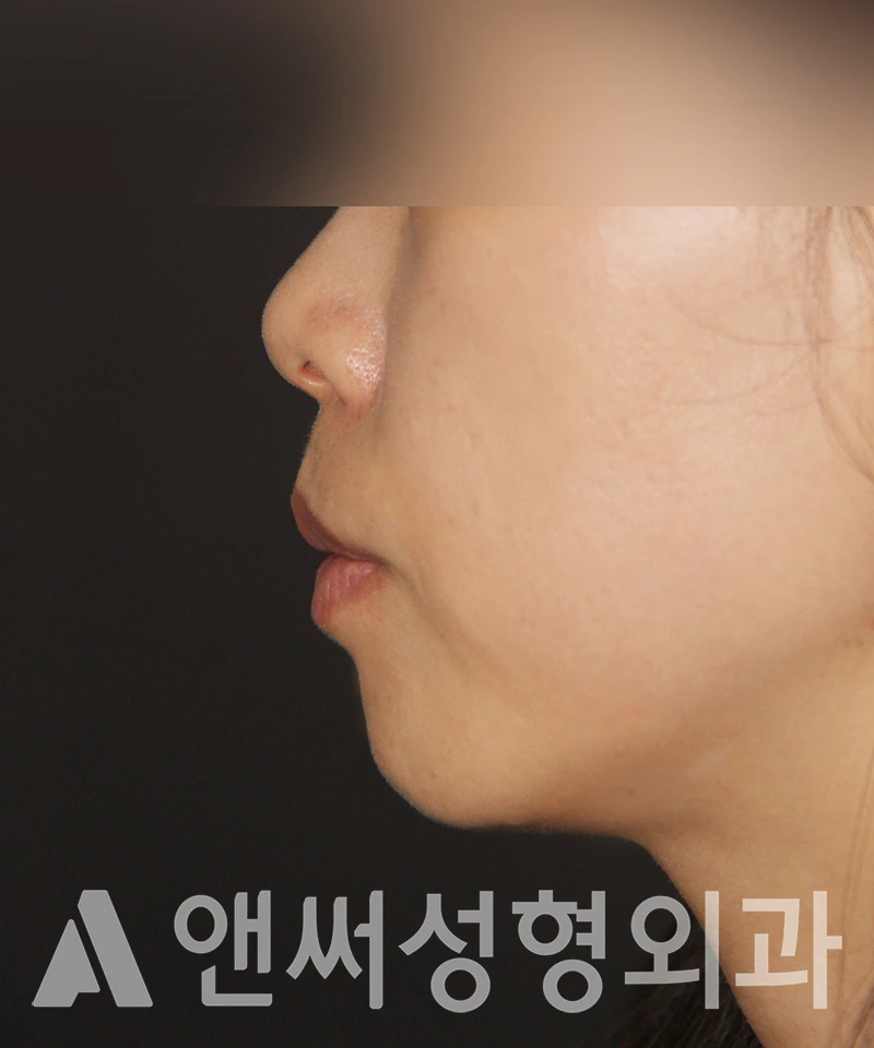 Answer Plastic Surgery case 451: Before