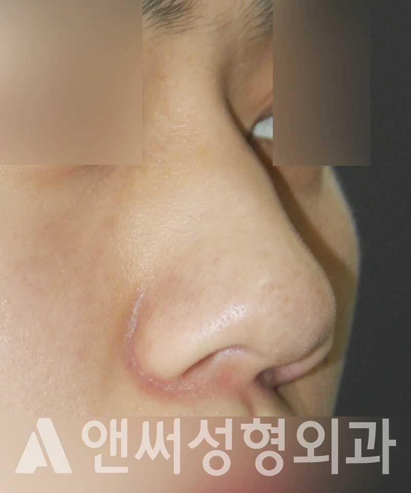 Answer Plastic Surgery case 450: Before
