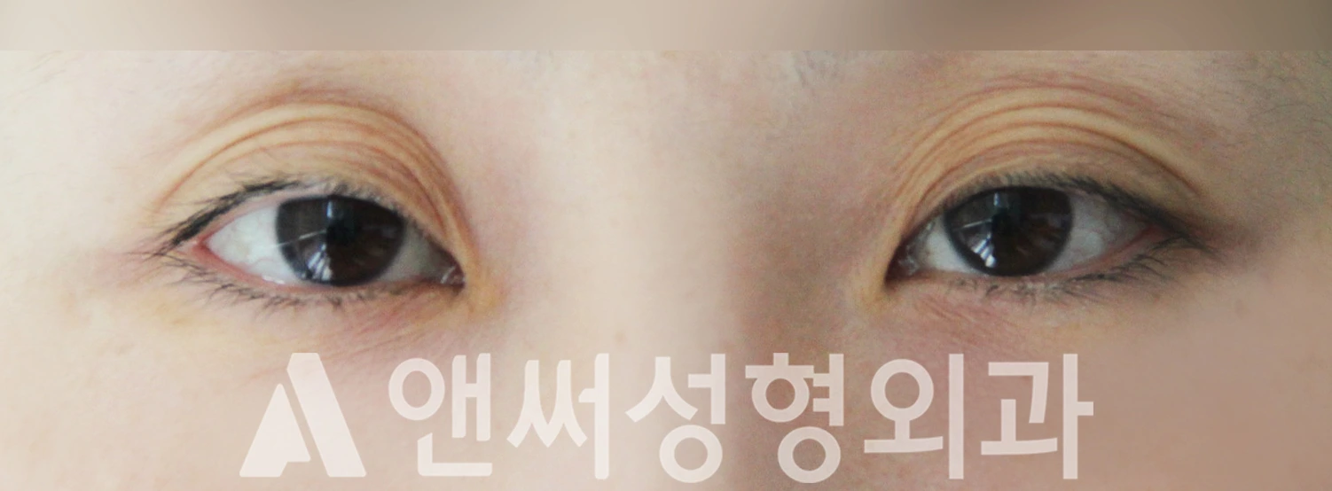 Answer Plastic Surgery case 448: Before